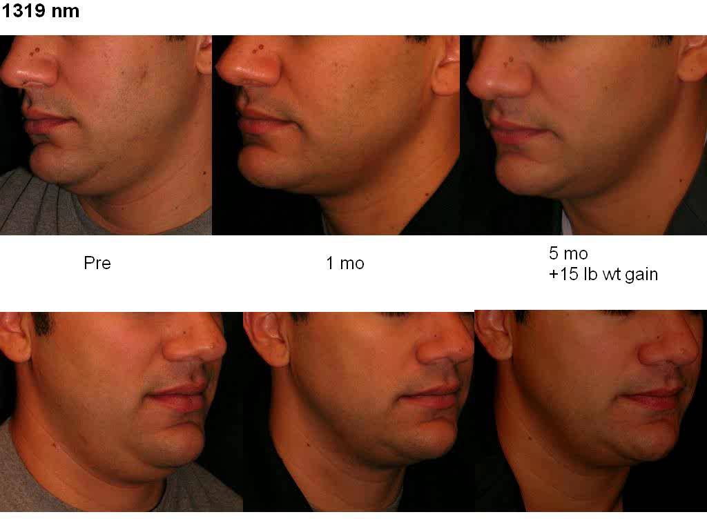 Thumbnail for Improve Submental Contours and Skin Laxity with Sciton Laser Technology