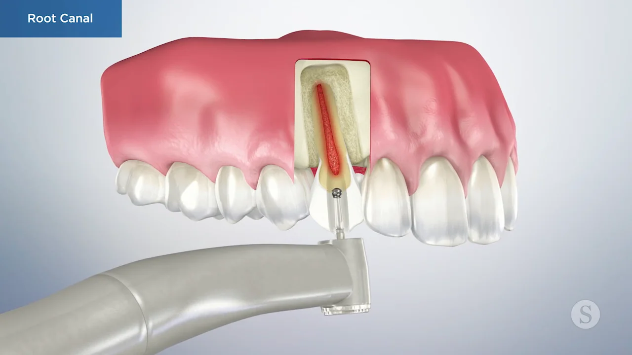 Repair Options for a Broken Tooth - Valley Neighborhood Dental