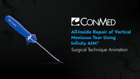 All-Inside Repair of a Vertical Meniscus Tear Using Infinity AIM™