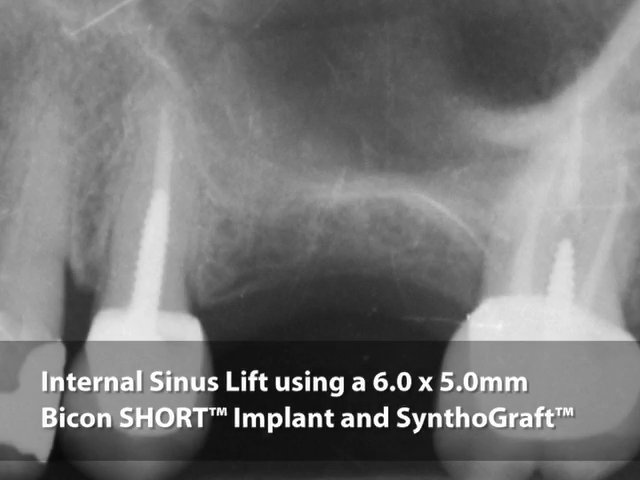 Placement Of A Bicon SHORT® Implant Using An Internal Sinus Lift And ...